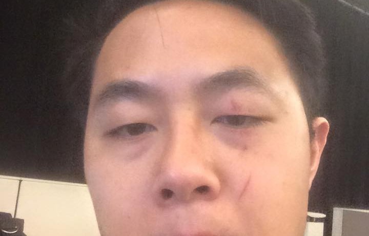 picture of Anthony Leong after mugging