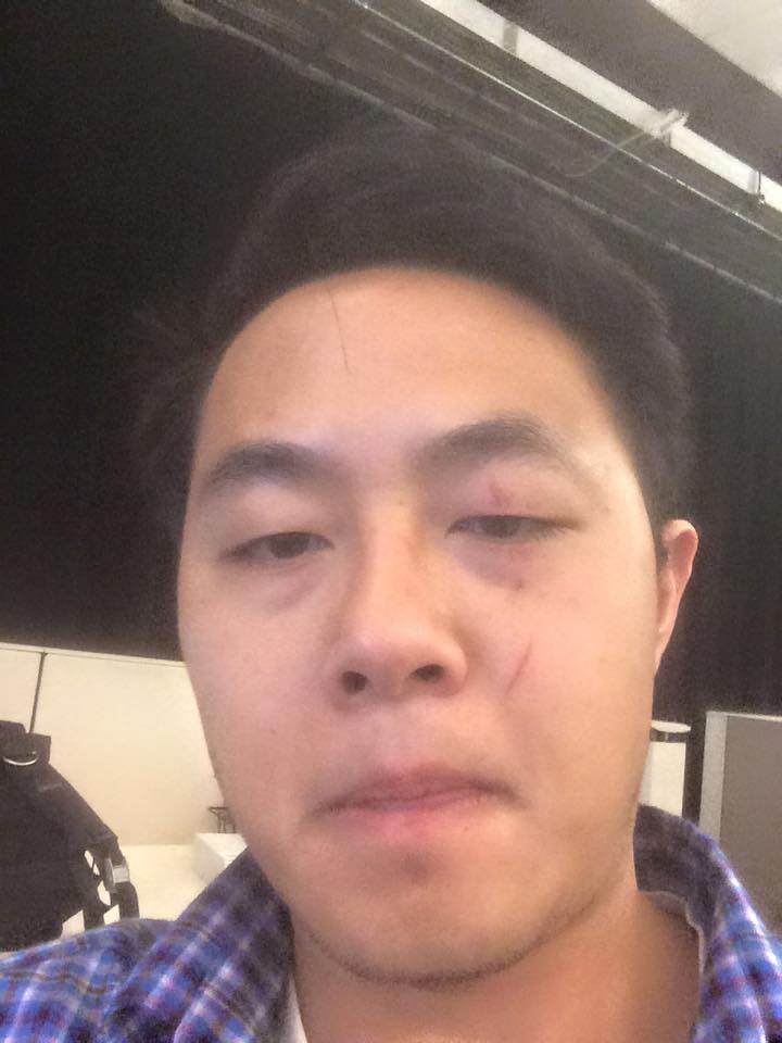 picture of Anthony Leong after mugging